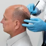 sapphire hair transplant