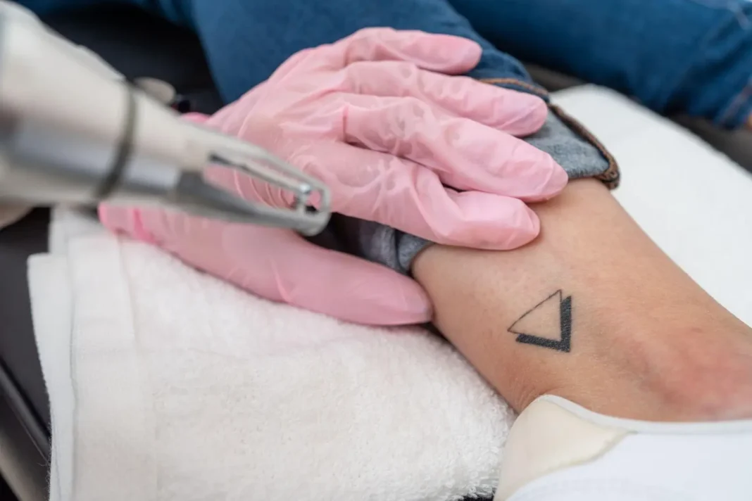 What to Expect During Your First Laser Tattoo Removal Session