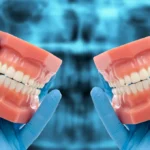 Long-Term Effects of Bruxism